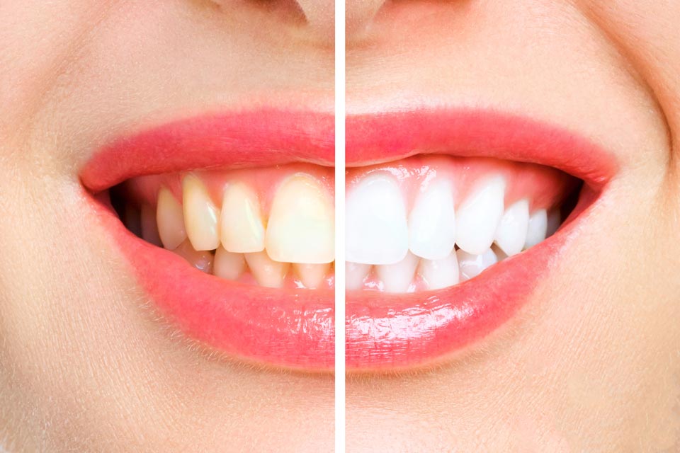 Foto de una boca dividida en dos para mostrar el antes y el después de un blanqueamiento dental