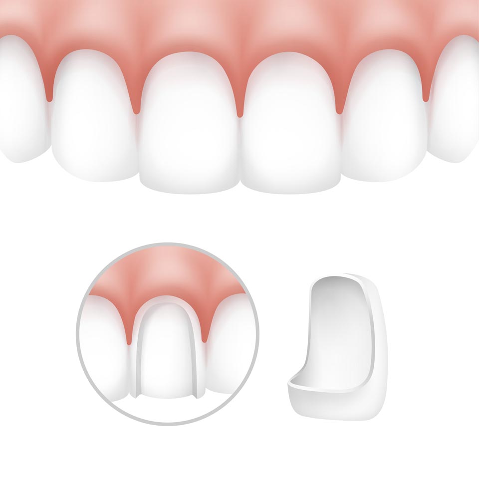 Ilustración de una carilla dental