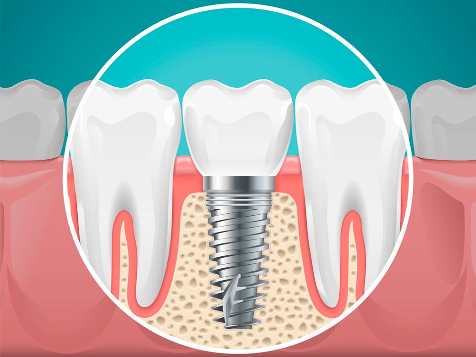 Ilustración de un implante dental