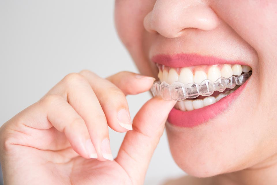 Mujer colocándose una ortodoncia invisalign en la boca