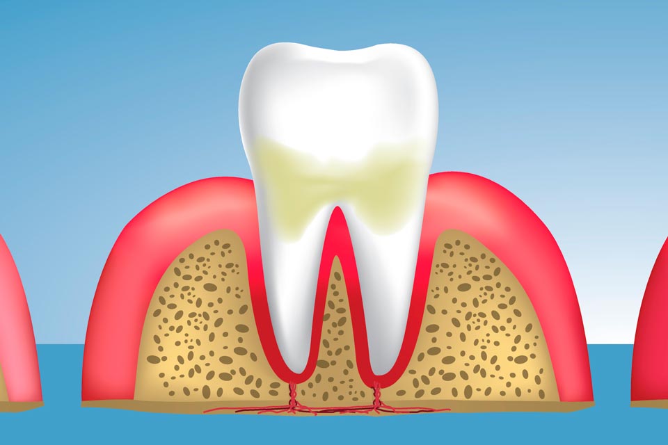 Ilustración de pieza dental afectada por sarro